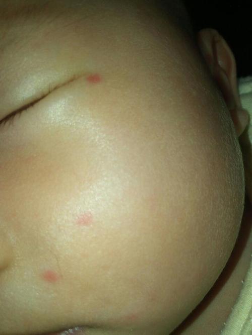 宝宝脸上有红点，一使劲就红，不使劲就下去了，是什么原因？为什么小孩的脸会红呢呢