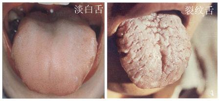 舌苔白腻，齿痕严重，是什么原因？为什么舌苔有齿痕呢呢