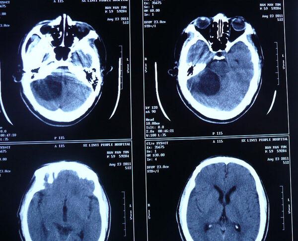 小脑左侧占位有可能是什么瘤？为什么小脑会长肿瘤呢-图2